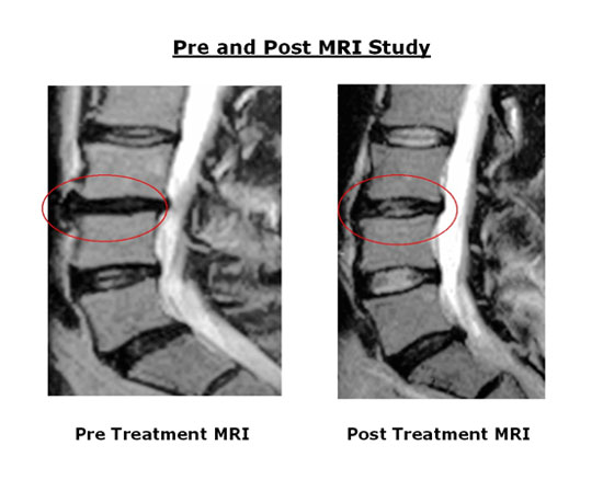 Idd Therapy | Spinal Decompression